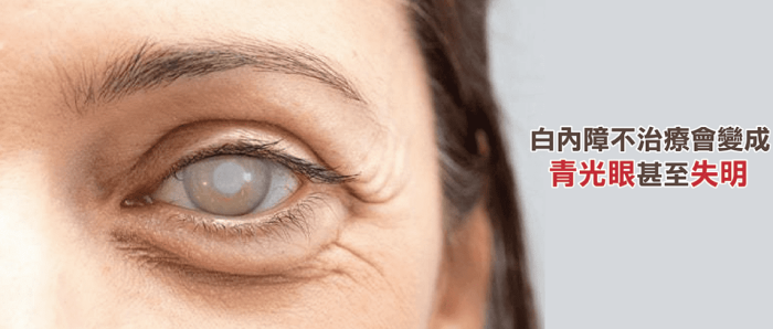 白內障 白內障