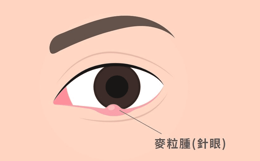 麥粒腫​