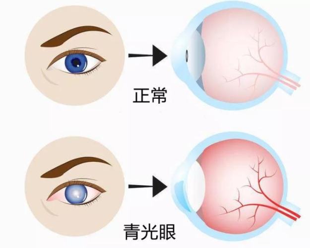 青光眼症狀前兆