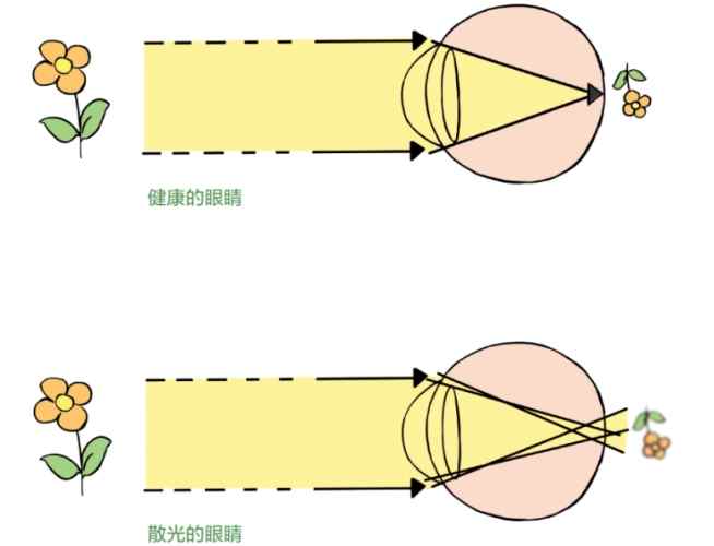 散光原因