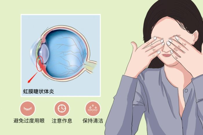 虹膜炎症狀