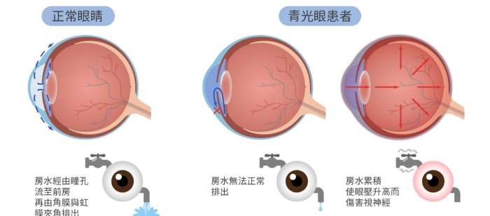 青光眼的治疗