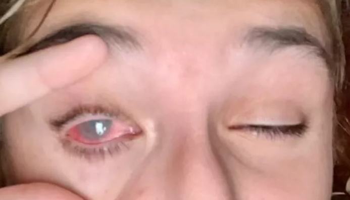 眼睛灼傷症狀