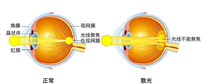 散光
