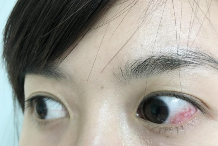 鞏膜炎的原因