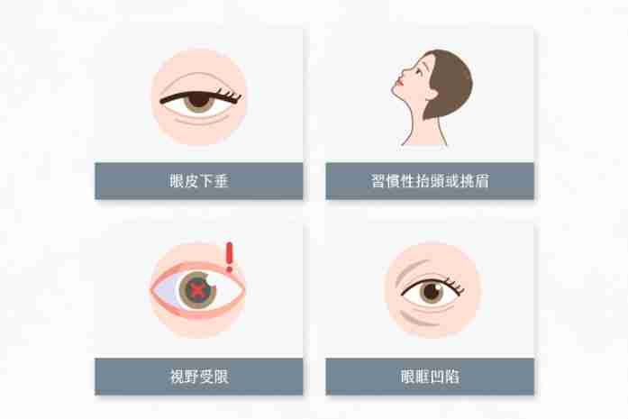 提眼肌訓練