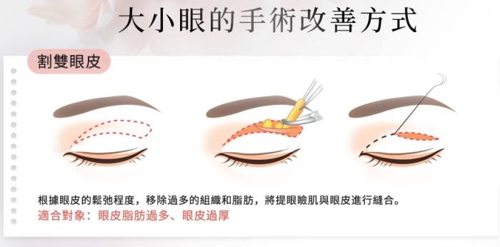 提眼肌手術過程