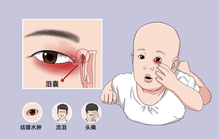 淚囊炎
