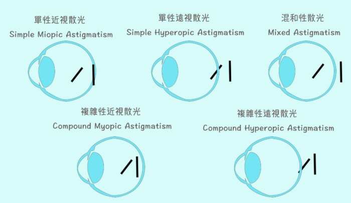 散光是什麼感覺
