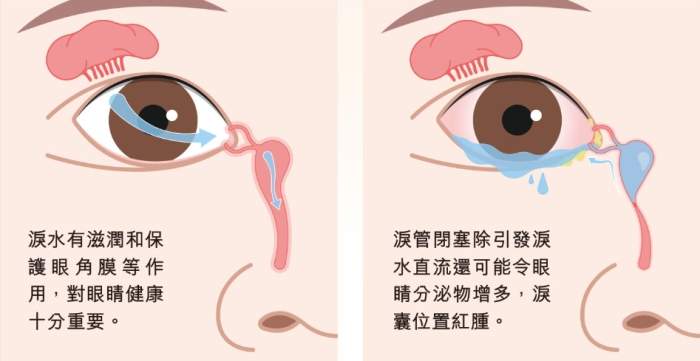 淚囊炎原因