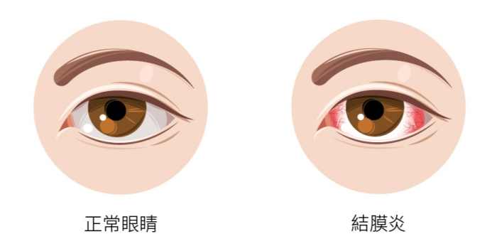 結膜炎症狀原因