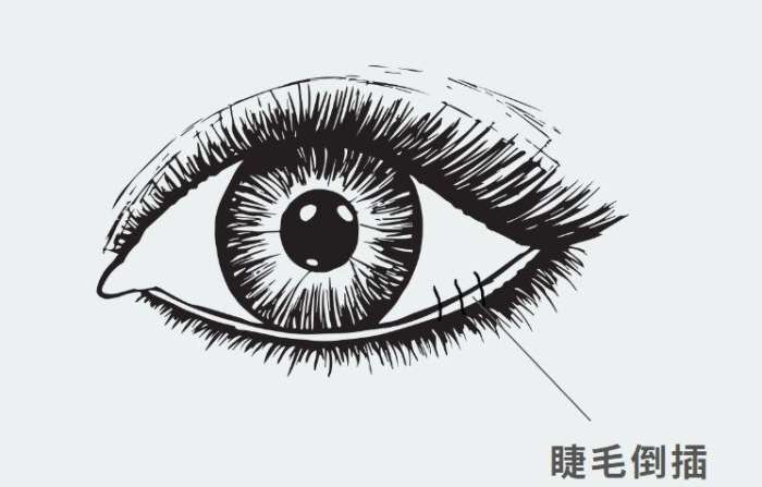 睫毛倒插 睫毛倒插