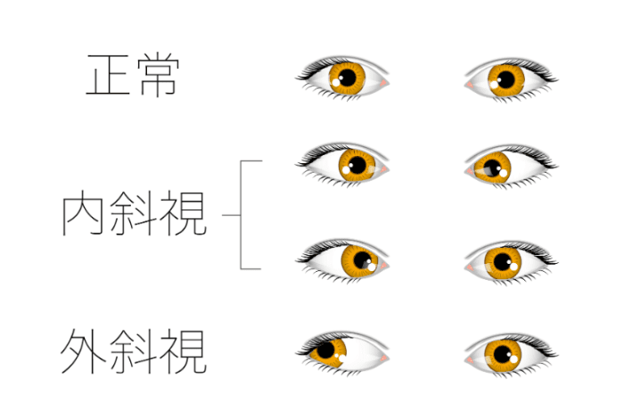 斜視 斜視