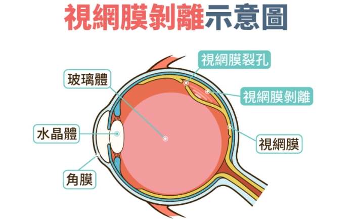 視網膜剝離前兆
