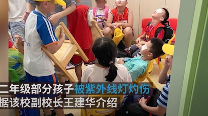 眼睛灼傷後遺症