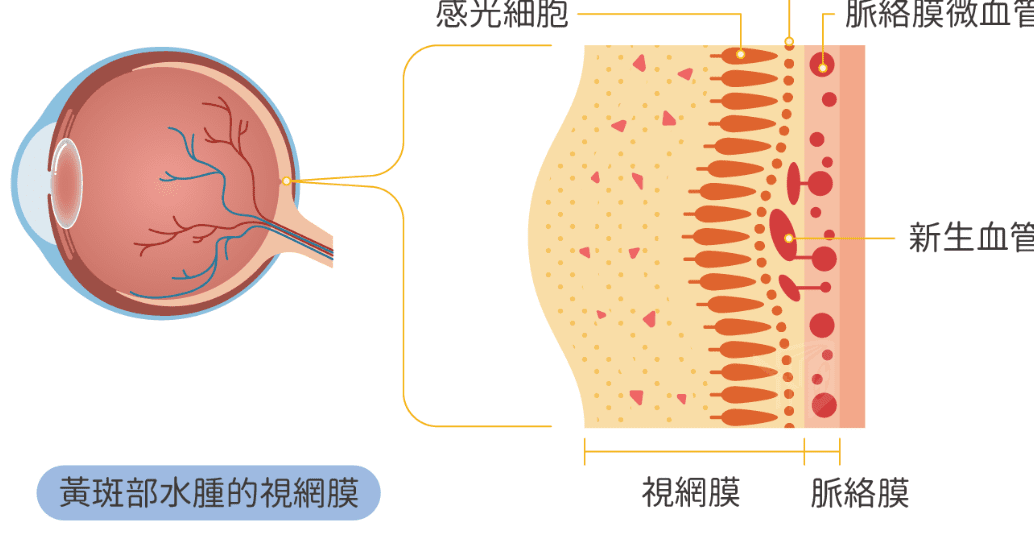 黃斑部病變原因 黃斑部病變原因