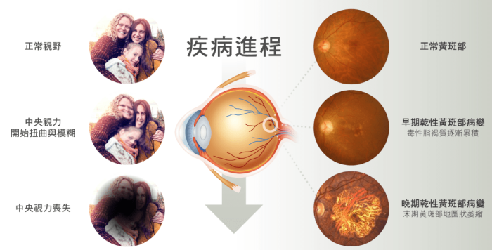 黃斑部病變常見問題 黃斑部病變常見問題