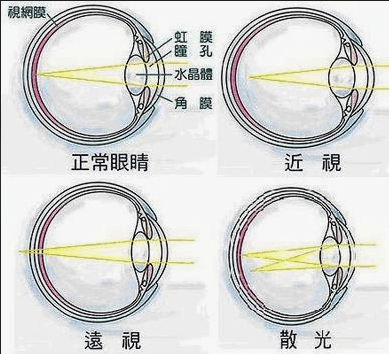 常見眼睛構造異常 常見眼睛構造異常