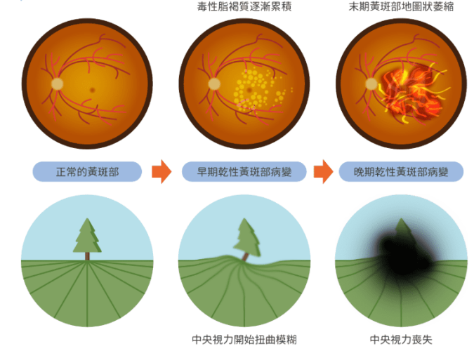 黃斑部病變症狀