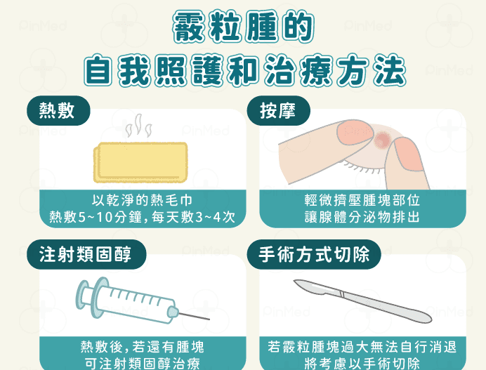 霰粒腫典型症狀與診斷方法 霰粒腫典型症狀與診斷方法