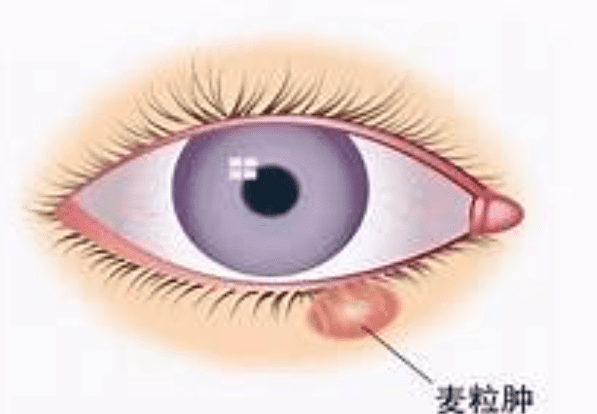 ​麥粒腫