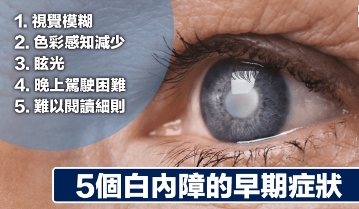 白內障原因