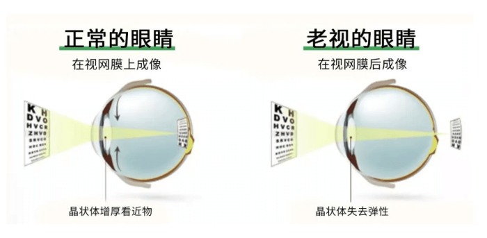老花眼是什麼