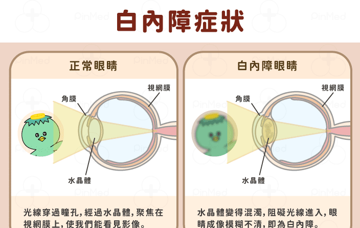 白內障人工水晶體