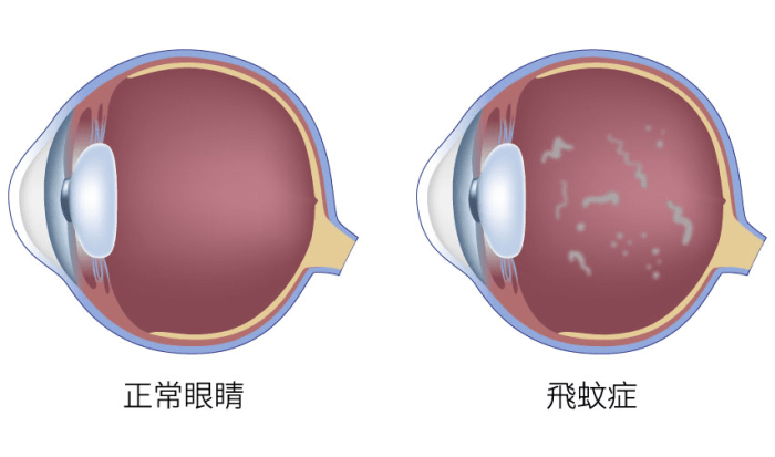 飛蚊症原因