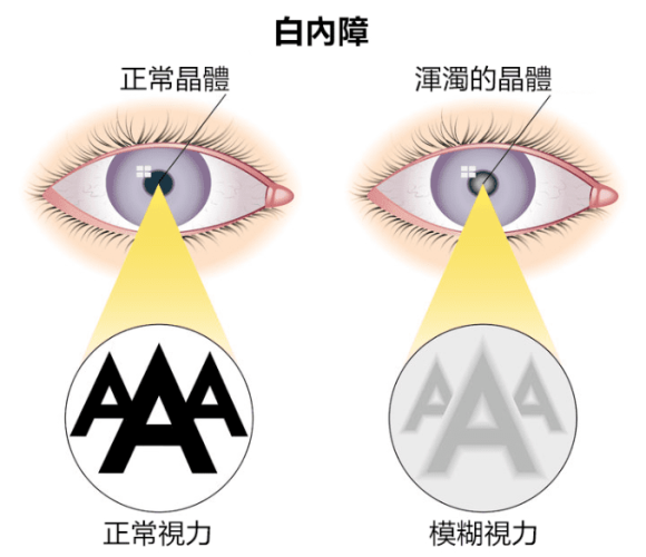 白內障手術