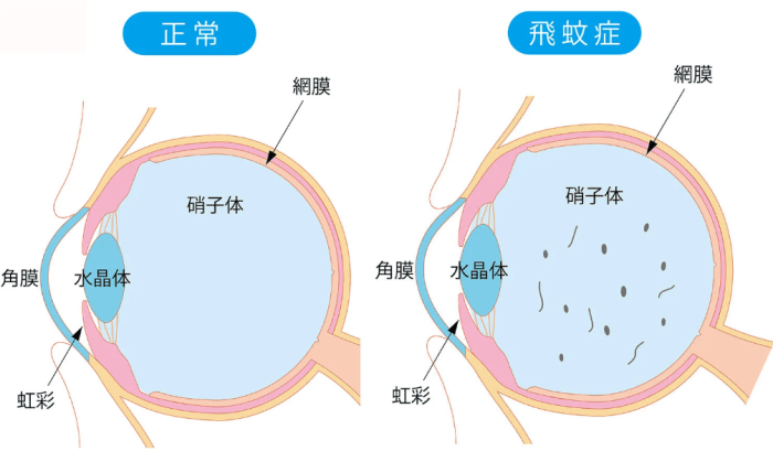 飛蚊症原因