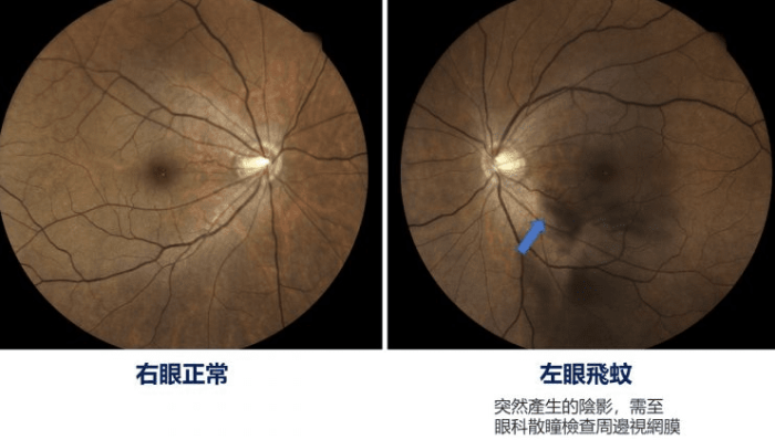 飛蚊症改善方法