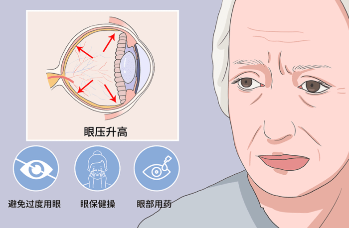 高眼壓症該如何治療