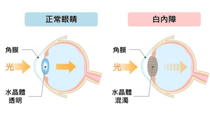 白內障初期症狀