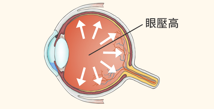 高眼壓症該如何治療