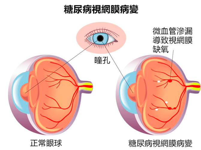 糖尿病眼睛疾病治療方法