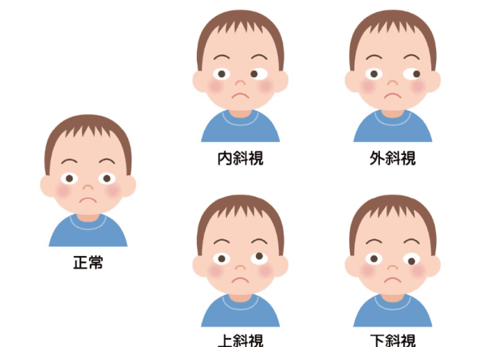 斜視的診斷方法