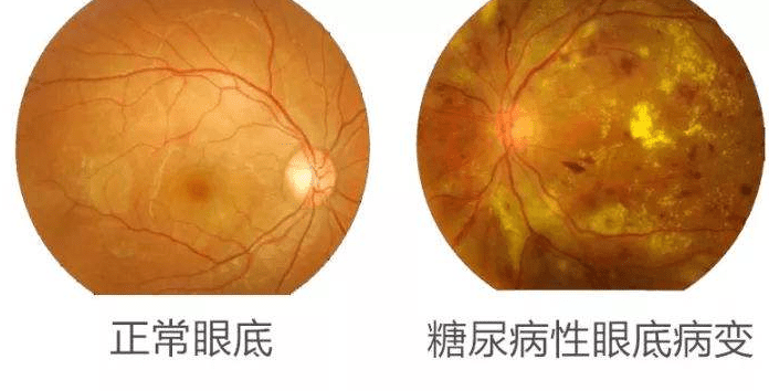 糖尿病眼睛疾病的種類