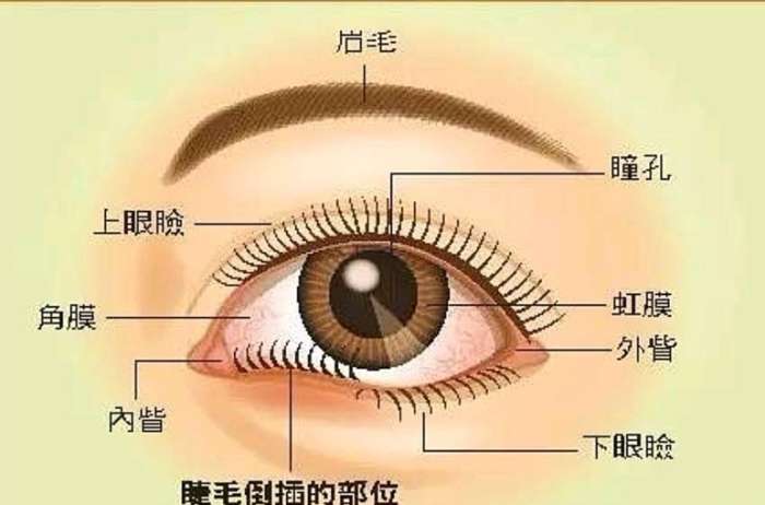 睫毛倒插的症狀