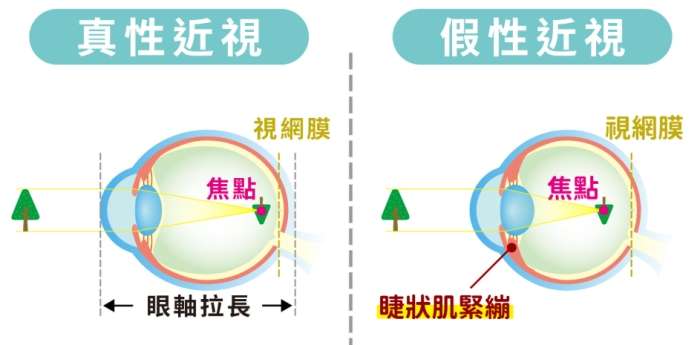 假性近視預防
