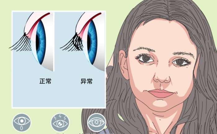 睫毛倒插的治療