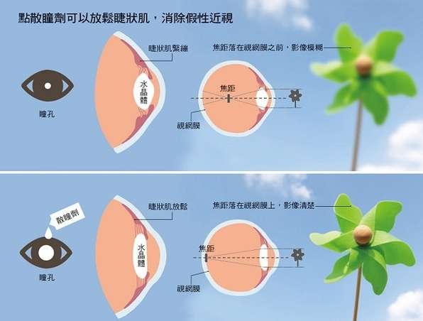 假性近視是什麼